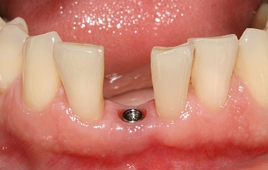 Zubní implantát straumann 1